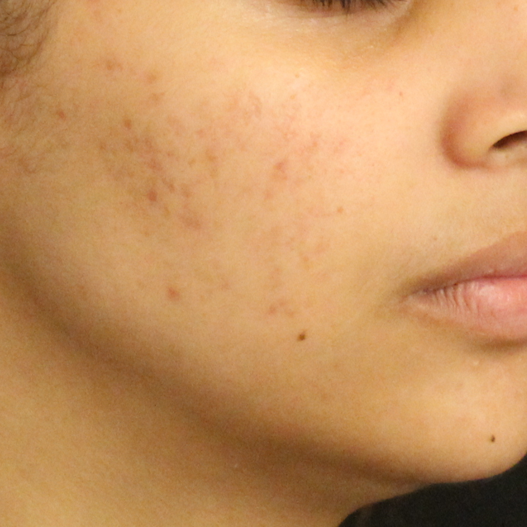 After treatment result for client: skin after completing the Face Reality program