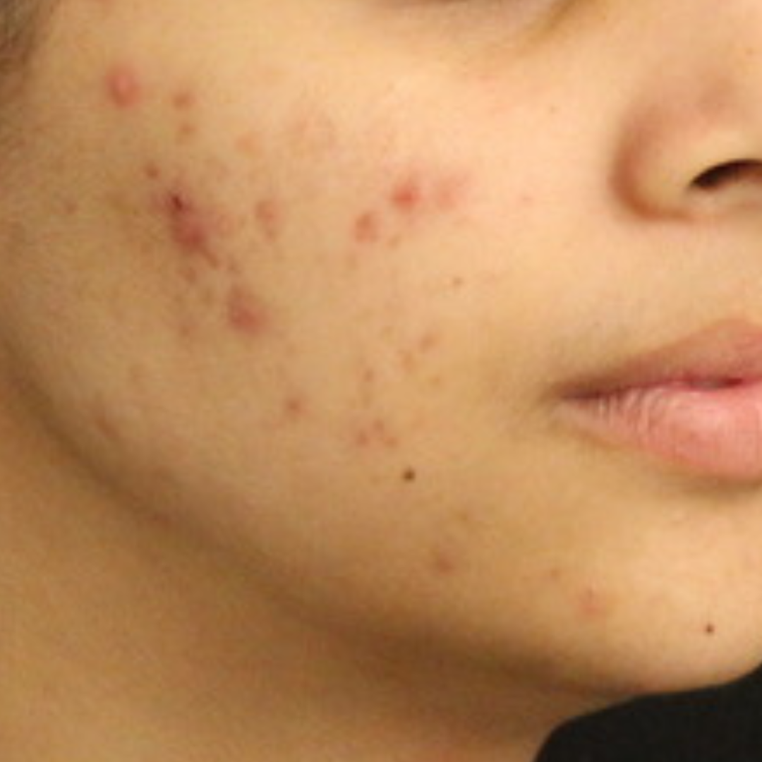 Before treatment for client: skin before starting the Face Reality program