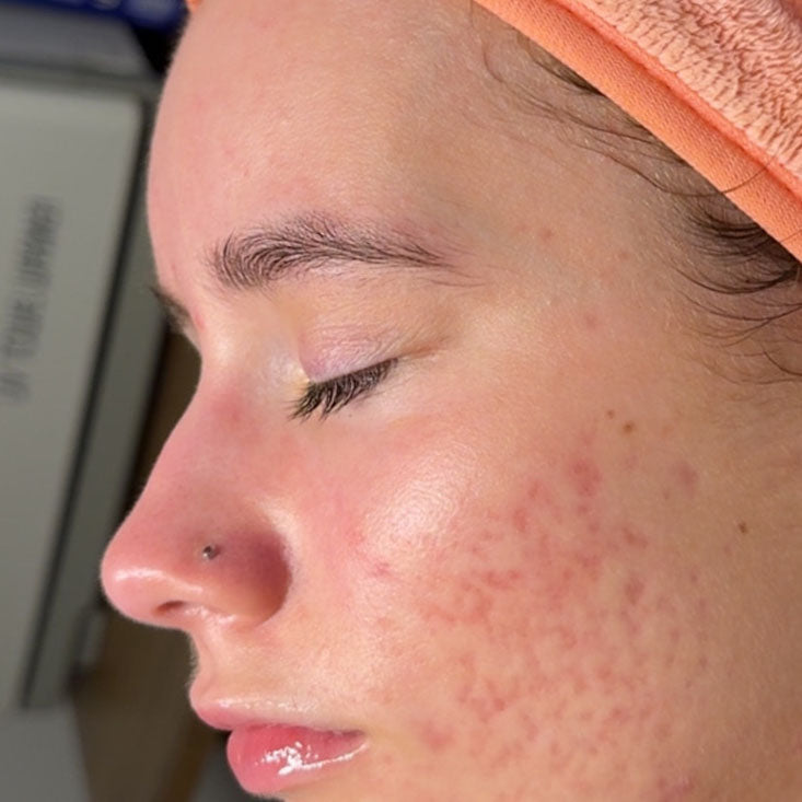 After treatment result for client: skin after completing the Face Reality program