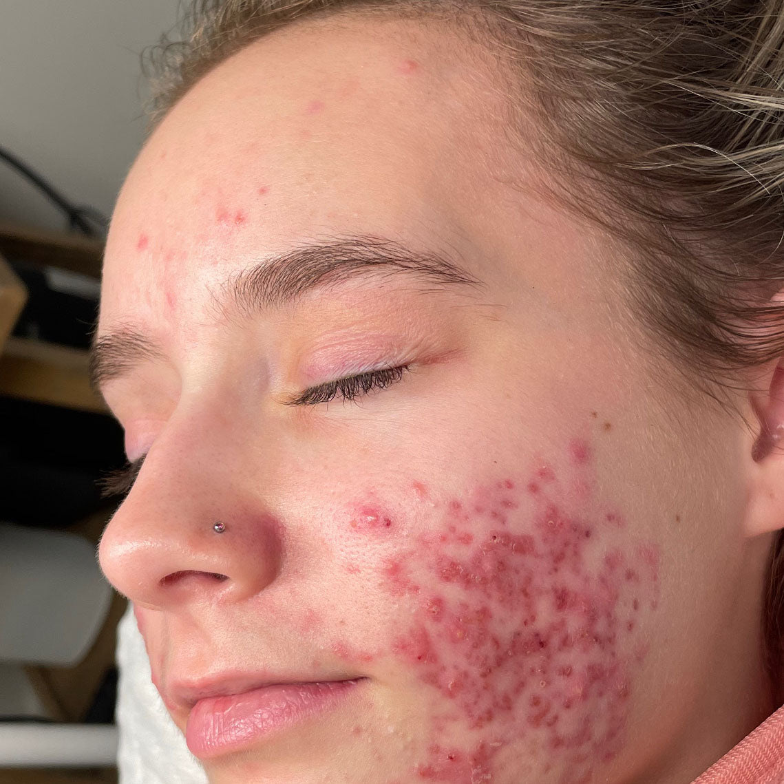 Before treatment for client: skin before starting the Face Reality program