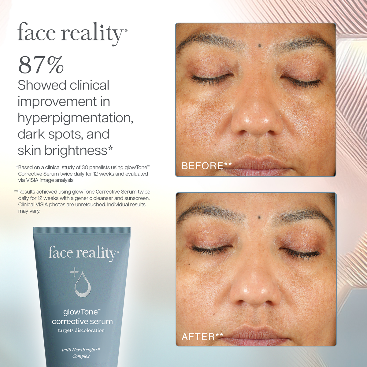 glowTone Corrective Serum clinical results graphic showing before-and-after study images. After 12 weeks of use, 87% of participants showed clinical improvement in hyperpigmentation, dark spots, and skin brightness.