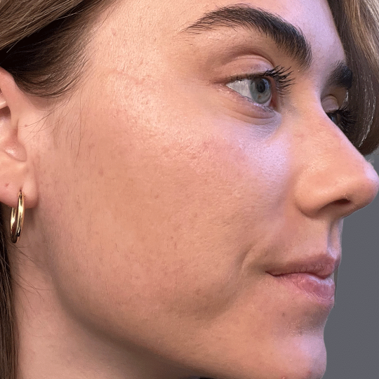 After treatment result for client: skin after completing the Face Reality program