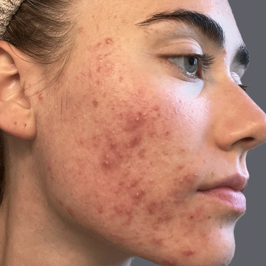 Before treatment for client: skin before starting the Face Reality program