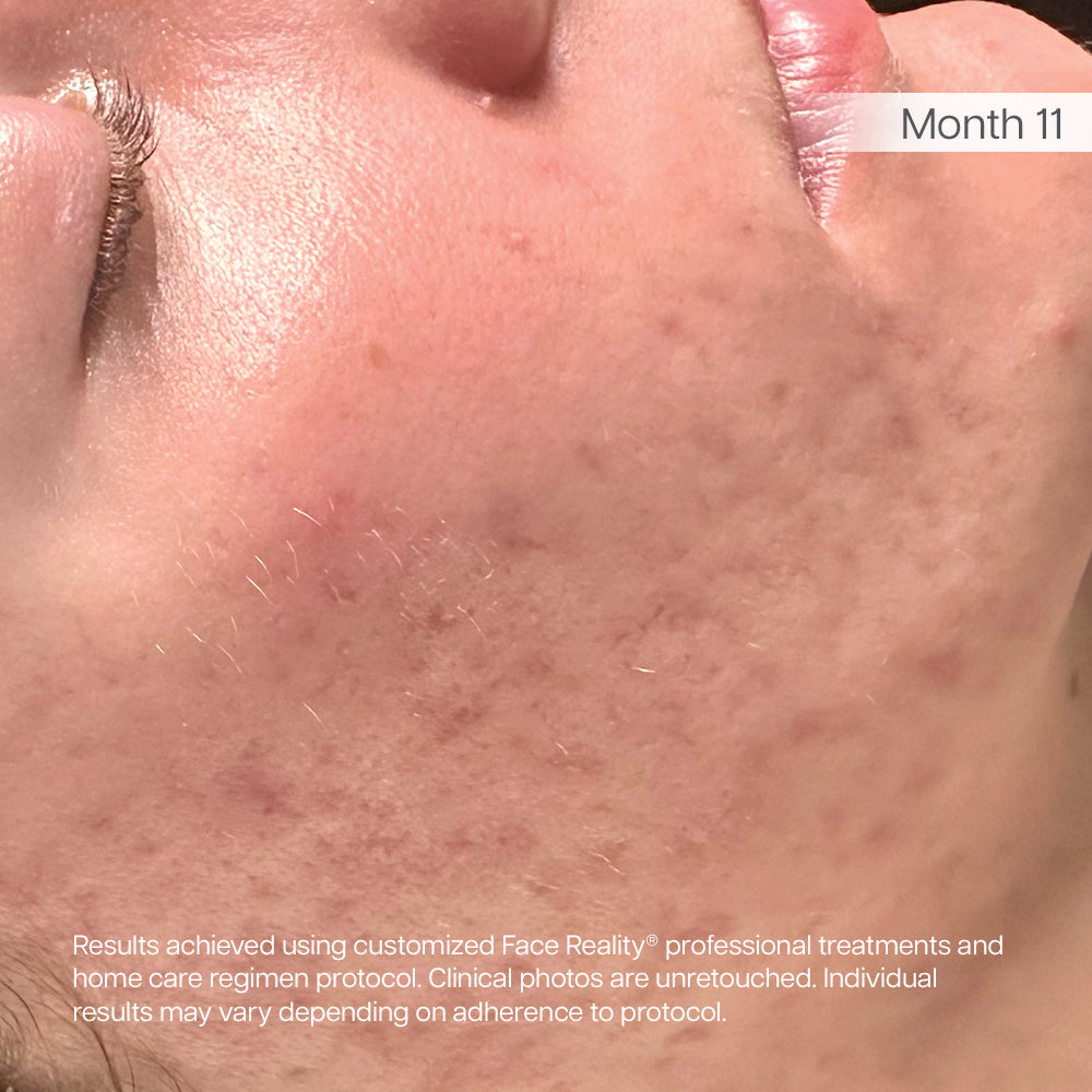 After treatment result for client 1: skin after completing the Face Reality program