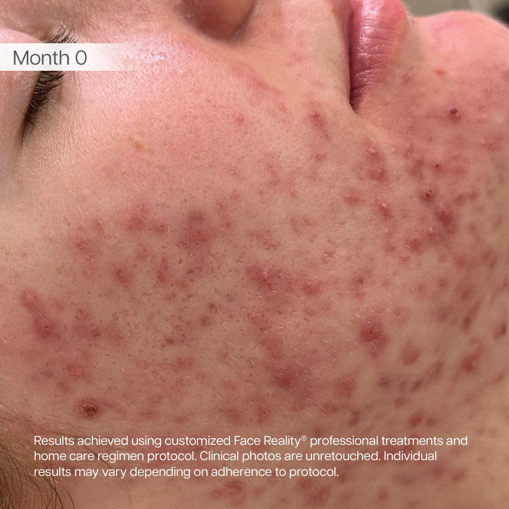 Before treatment for client 1: skin before starting the Face Reality program